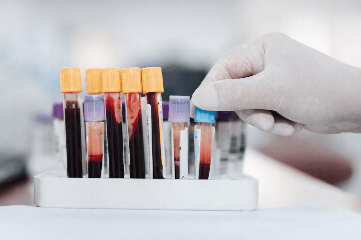 Blood sample vials in laboratory